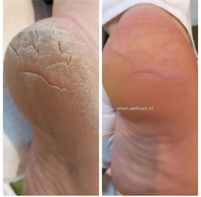Hardware pedicure before and after heel result
