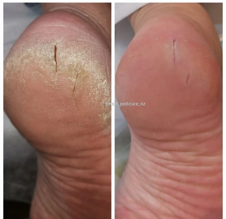 Cracked heel before and after hardware pedicure