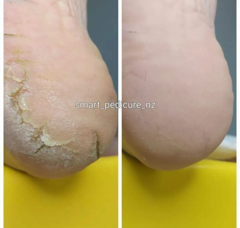 Hard skin before and after professional foot care