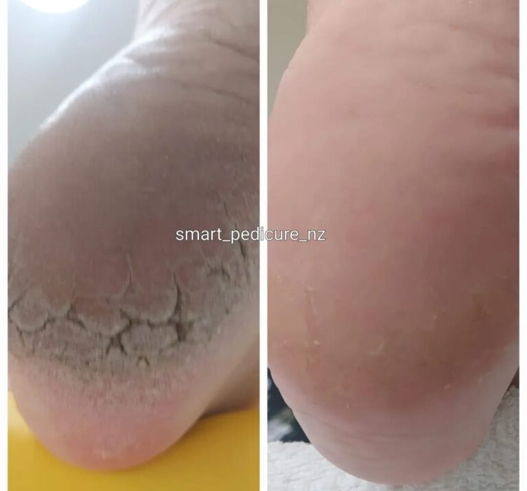 Cracked heel before and after men’s foot care