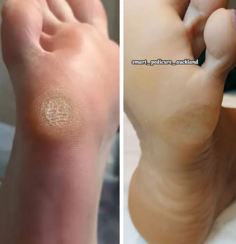 Callus on the ball of the foot before and after removal, North Shore