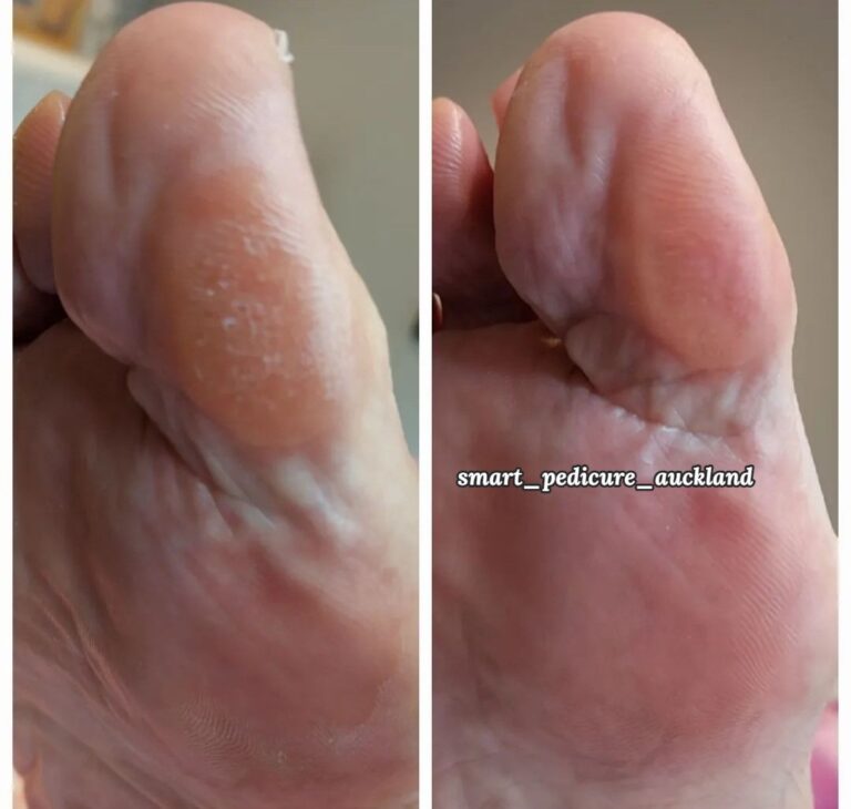 Calluses on the sole before and after senior foot care, Glenfield