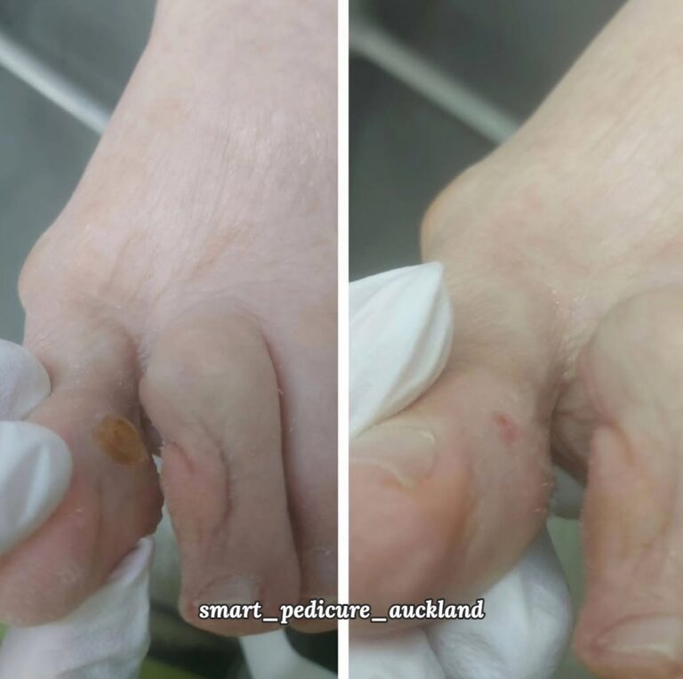 Corn between the toes before and after removal, senior foot care Auckland