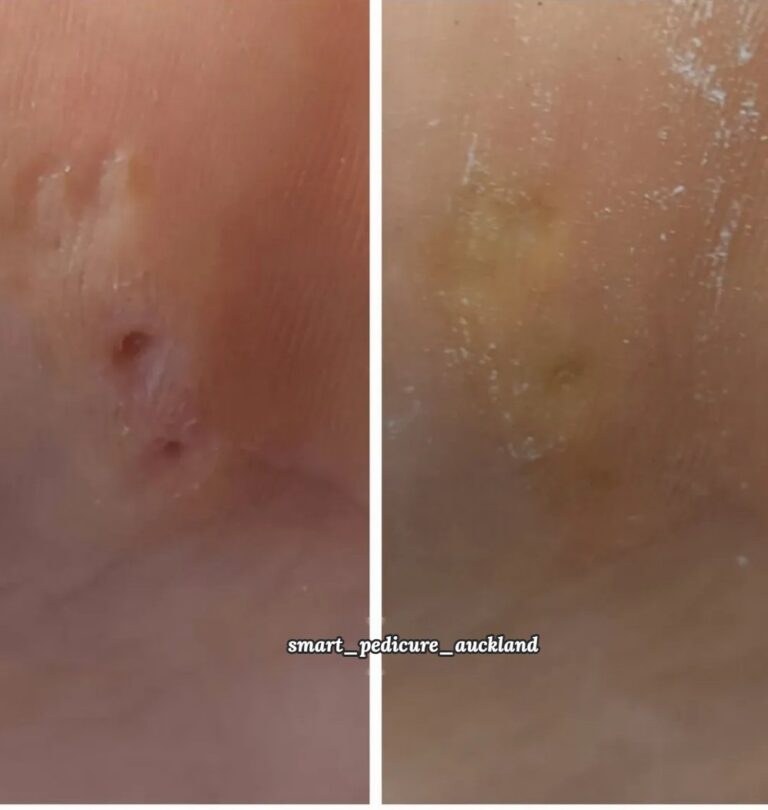Corn with a hard core on the sole before and after removal, Auckland
