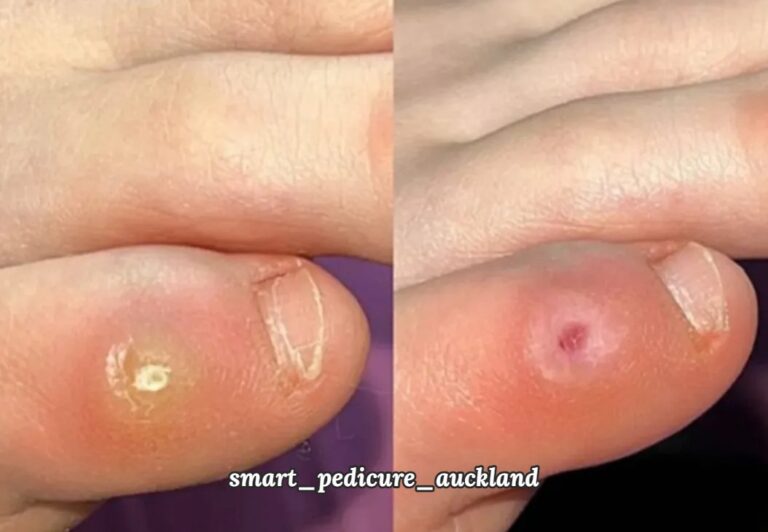 Corn on a toe before and after removal, North Shore