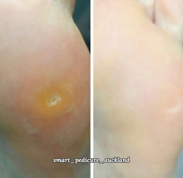 Corn on the sole of the foot before and after removal, Glenfield