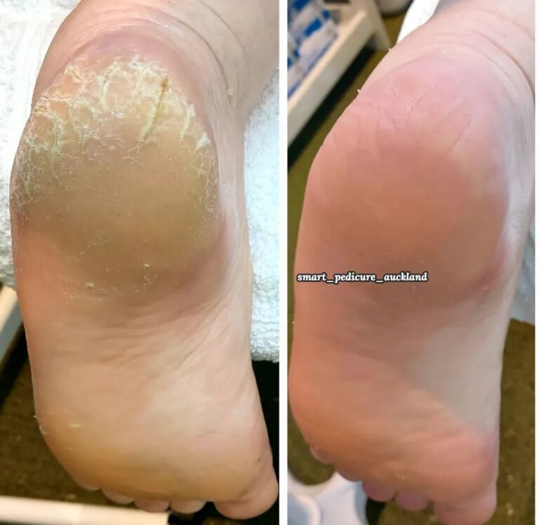 Cracked, dry heel before and smooth heel after a hardware pedicure at Smart Pedicure NZ, Glenfield