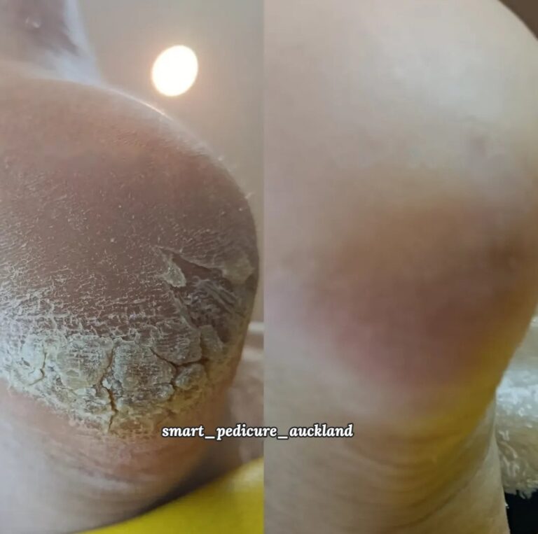 Cracked heel before and after a hardware pedicure, Smart Pedicure Glenfield