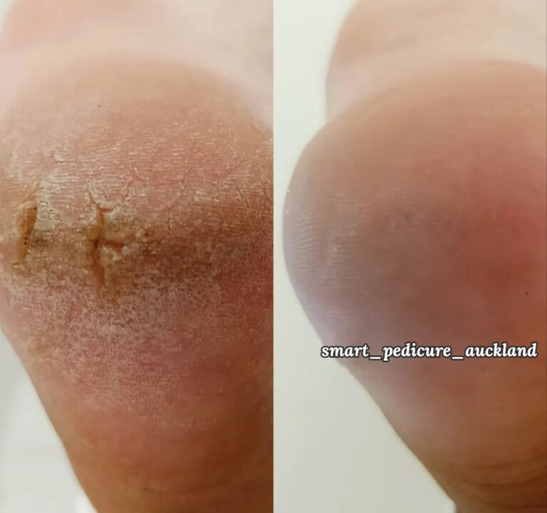 Cracked heels before and after a hardware pedicure, North Shore Auckland