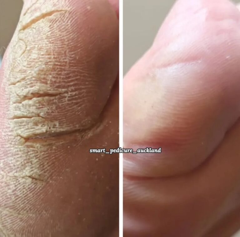 Deep cracks along the edge of the heel before and after a pedicure, North Shore