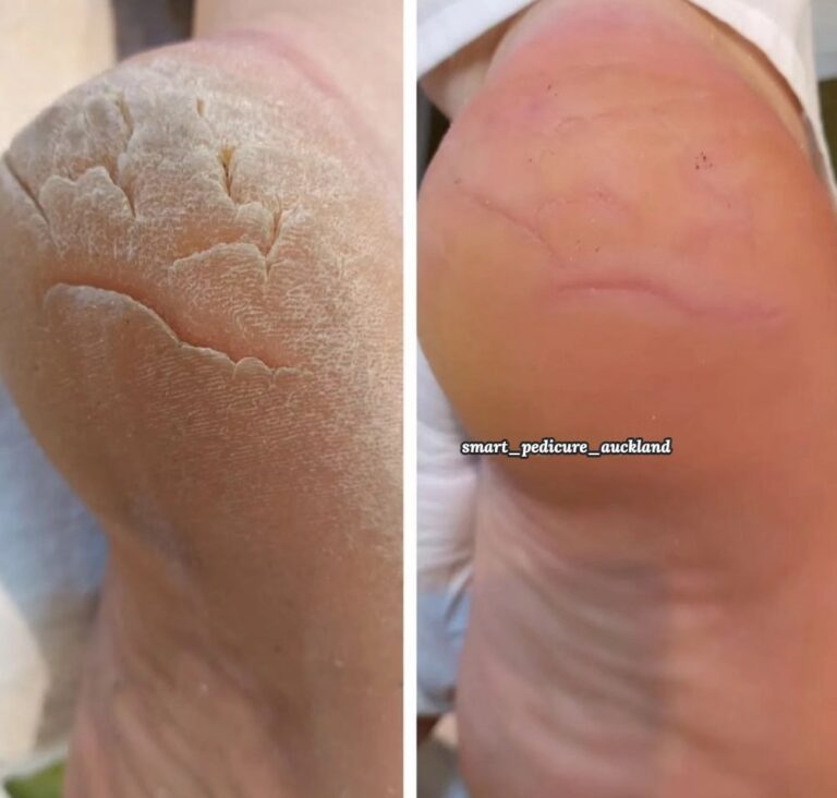 Deep heel cracks before and smoother heel after a hardware pedicure, North Shore Auckland