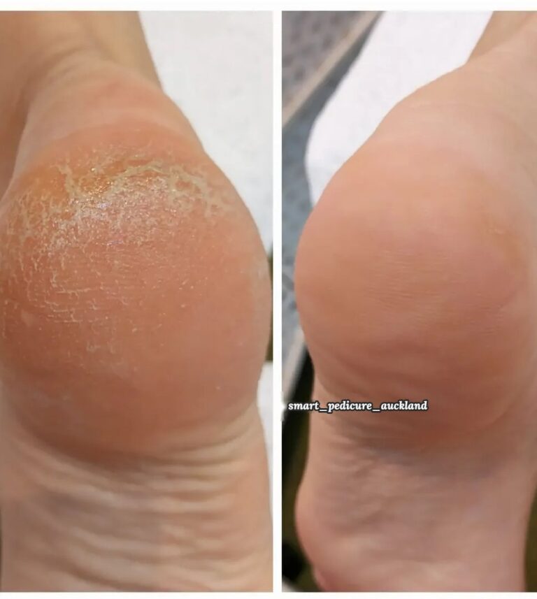 Dry, rough skin on the heel before and smooth skin after a hardware pedicure, Glenfield