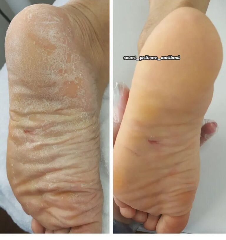 Dry, thick skin across the whole sole before and after a hardware pedicure, Glenfield