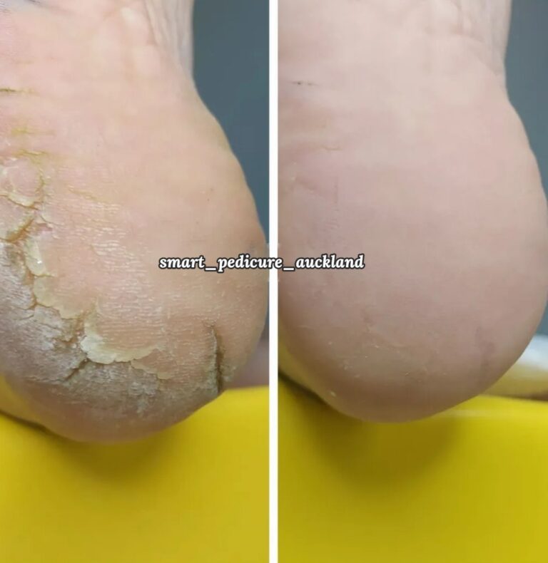 Hard rim of skin around the back of the heel before and after a pedicure, Auckland