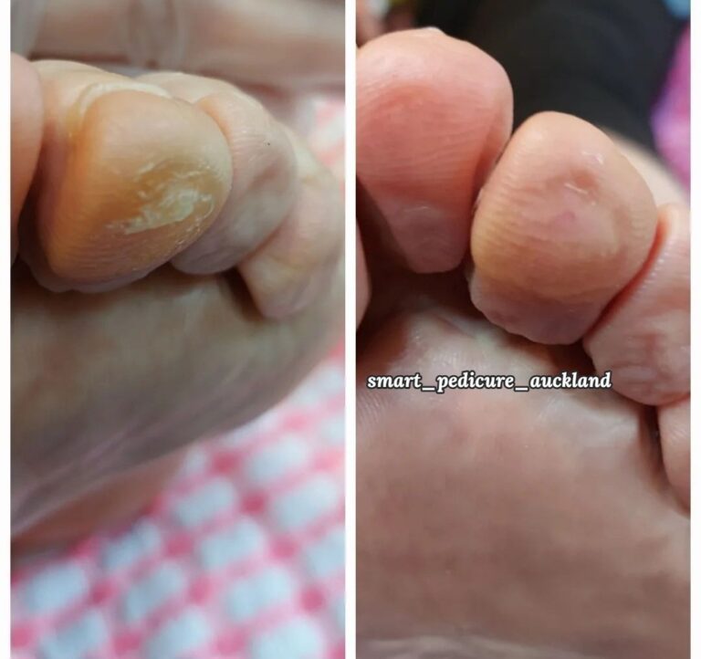 Hard skin on curled toes before and after senior foot care, Glenfield