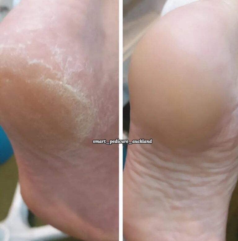 Hard skin on the heel before and after callus removal, Glenfield