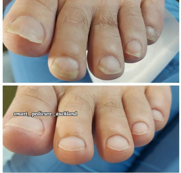 Toenails and cuticles before and after a hygienic pedicure, Glenfield