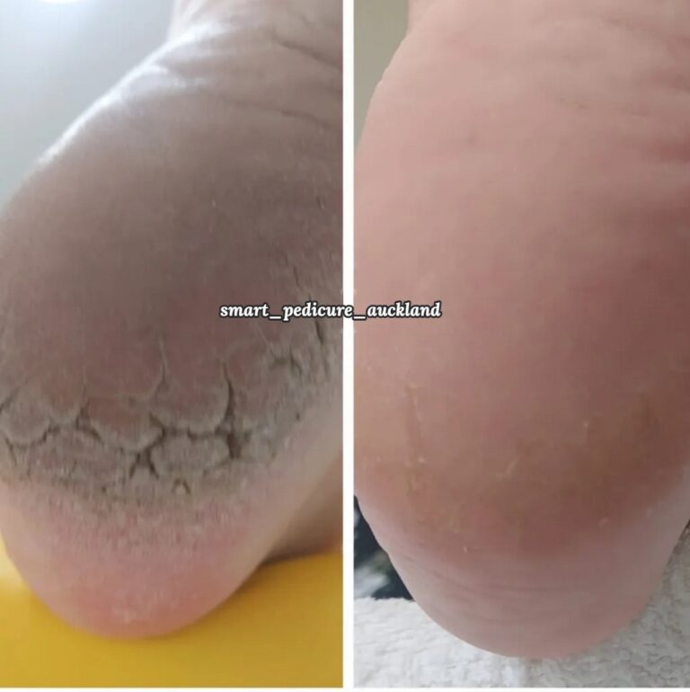 Grey, rough heel skin with fine cracks before and after a hardware pedicure, Glenfield