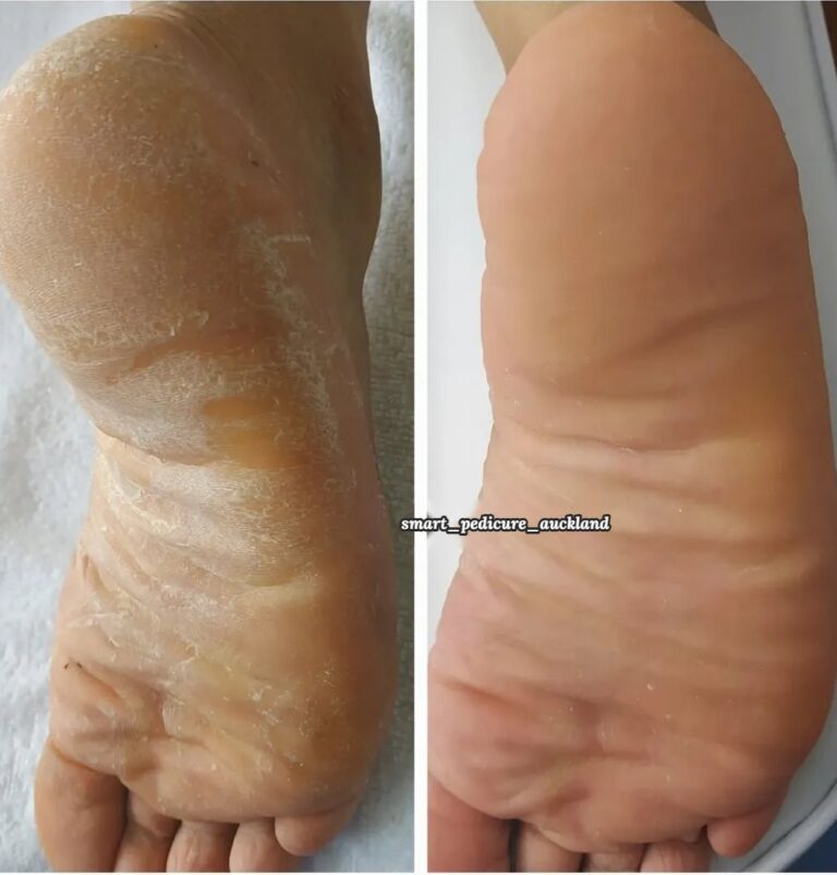 Rough, dry skin on the sole and heel before and after a pedicure, Auckland