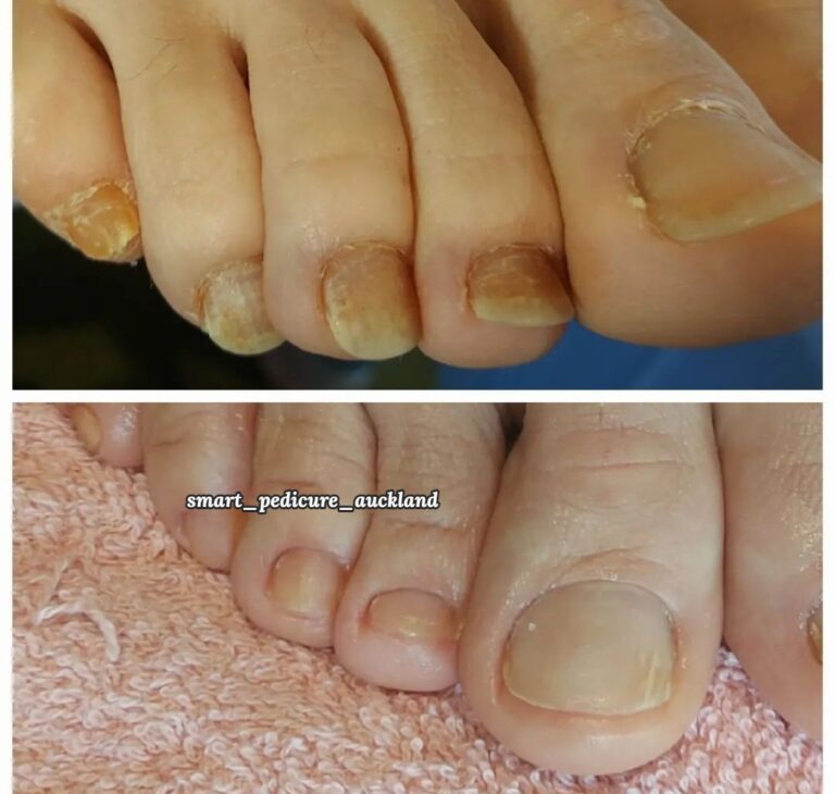 Older toenails before and after a hygienic pedicure, North Shore