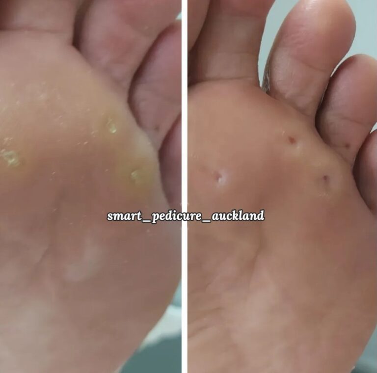 Small corns on the ball of the foot before and after removal, Glenfield
