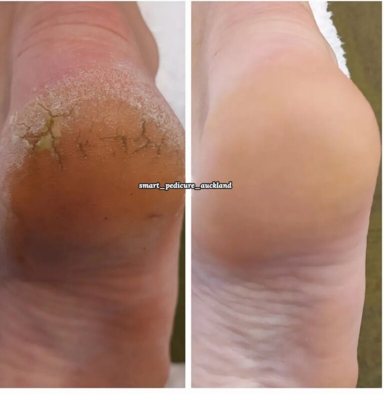 Thick, dry skin around the heel before and after a hardware pedicure, Glenfield
