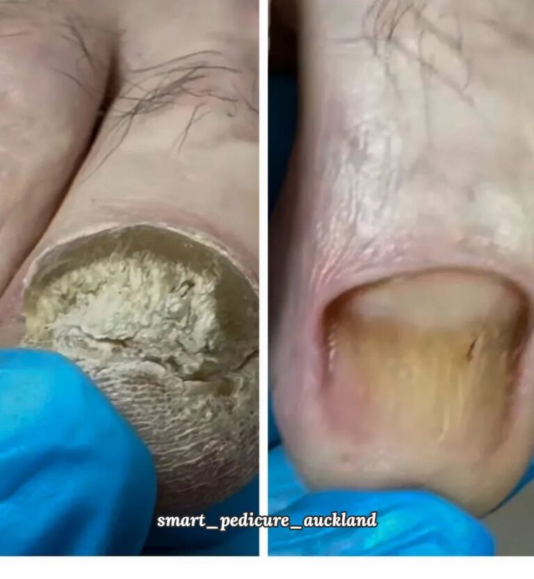 Thickened toenail before and after being trimmed and thinned, Glenfield