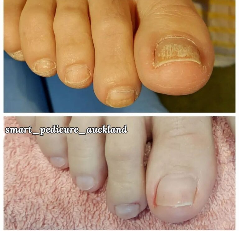 Thick, yellowed toenails before and after a senior pedicure, Glenfield